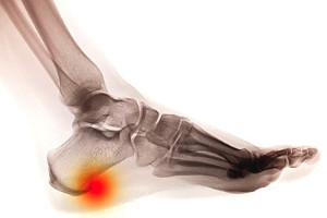 Exercises for Heel Spurs