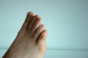 Managing Corns and Calluses