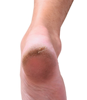 Possible Causes of Cracked Heels