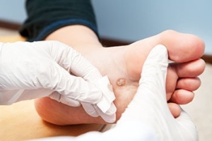 Plantar Warts in Public Pools