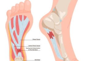 Facts About Plantar Fasciitis and Its Symptoms
