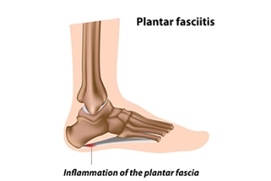 Plantar Fasciitis in Cyclists