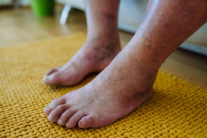 Understanding Diabetic Limb Salvage