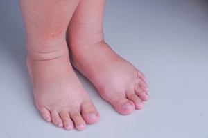 Why Are My Feet and Ankles Swollen?