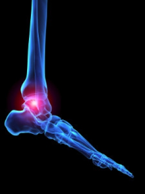 What is Rheumatoid Arthritis?