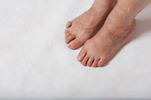 Orthotics May Help Your Hammertoe