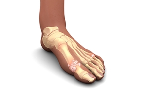 Drinking Beer Can Contribute to Gout
