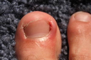 Can An Ingrown Toenail Cause Pain?