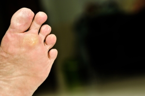 Plantar Warts and HPV Strains