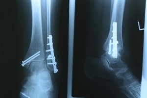 Possible Causes of Stress Fractures