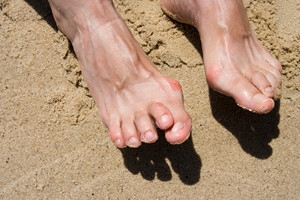 Possible Treatments for Hammertoe