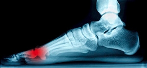 What Can Cause Sesamoiditis?