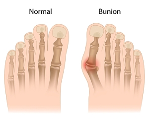 What to Know About Bunions